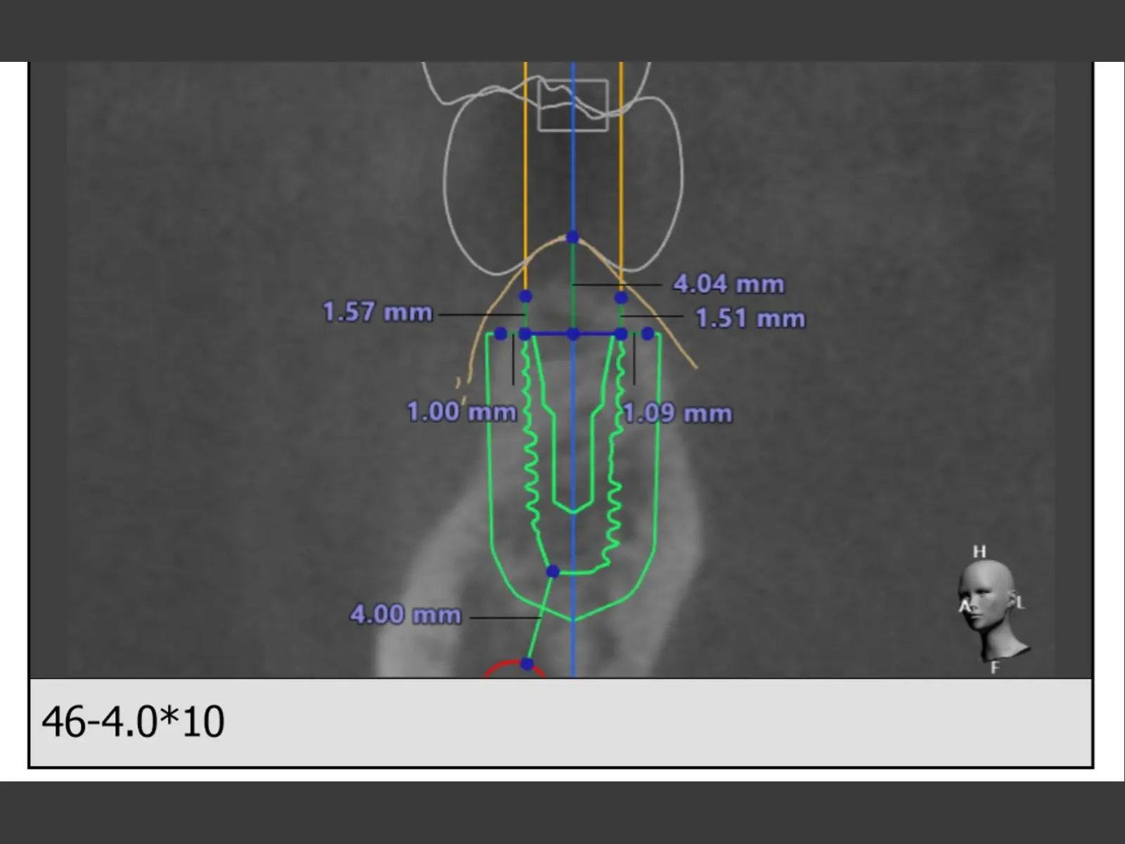 以 CBCT 規劃植體角度、深度與神經距離的術前影像